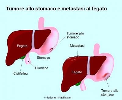 Aspettativa di vita dopo trapianto di fegato